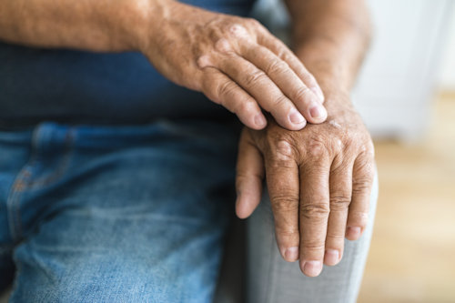 elderly-man-suffering-from-psoriasis-on-hands-2022-06-02-10-08-56-utc.jpg